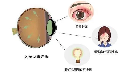 最新降眼压药物，重塑视界的新希望之光