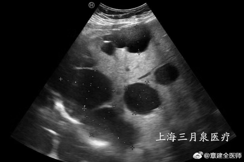 多囊肝多囊肾最新治疗步骤指南，最新治疗方法解析